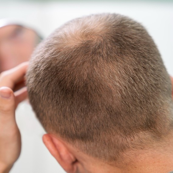 Battling Hair Loss: The Role of Testosterone and Hair Care Medications